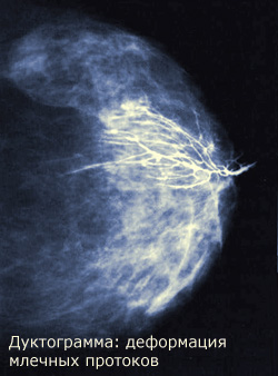 Внутрипротоковая папиллома молочной железы фото